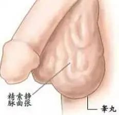 精索静脉曲张是如何影响男性生育的